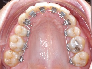 arcs-individualises-orthodontie-linguale