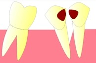 carie-parodontite