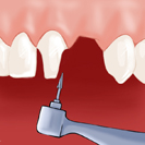 Préparation des dents adjacente
