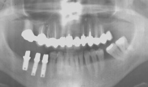 remplacement de trois dents par trois implants