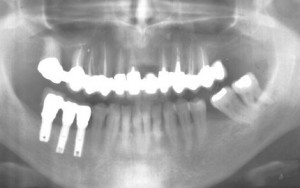 remplacement de trois dents par trois implants: couronne en place