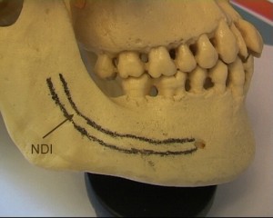 tracé du nerf dentaire sur une mandibule sèche