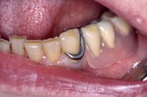 Moyen de fixité crochet prothèse dentaire dentier