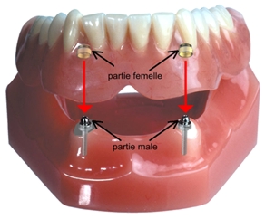 Prothese_Dentaire_Amovible_Partielle_Mixte