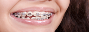 appareil-dentaire-orthodontique-multi-bagues