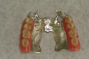 prothèse dentaire chassis métallique