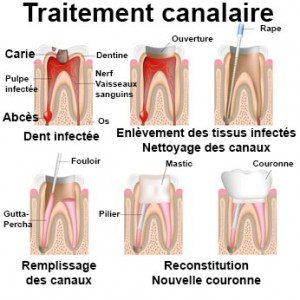 traitement endodontique