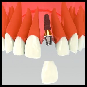 implant dentaire en place recevant sa cournne