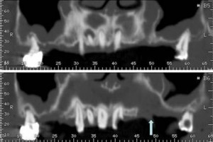 Images infectieuses apicales dépistées sur un scaner du maxillaire