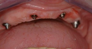 prothèse complète fixe sur 4 implants vue implants nantes dentiste