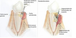 parodontite2