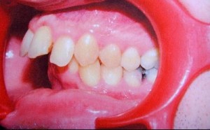 Les dents supérieures trop "en avant" risquent d’être fracturées en cas de choc