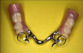 prothèse dentaire adjointe partielle