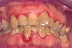 plaque tartre gingivite parodontite