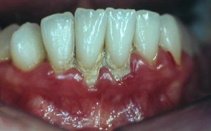 plaque tartre gingivite parodontite