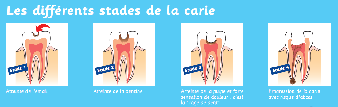 Les quatre stades de la carie, de l'émail jusqu'à l'abcès