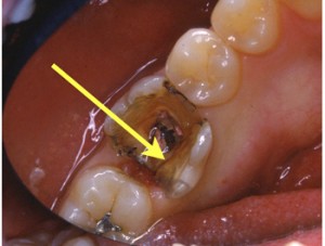 Après la dépose de l'amalgame, le trait de fracture apparaît (flèche)