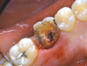 Le morceau fracturé a été enlevé : la fracture va loin sous la gencive
