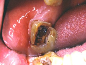 Autre fracture de dent dévitalisée : cette dent devra être extraite